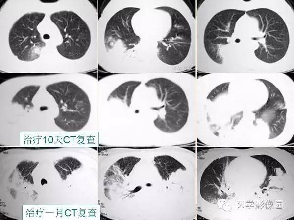 【PPT】隐源性机化性肺炎