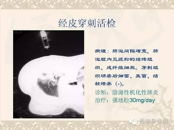 【PPT】隐源性机化性肺炎