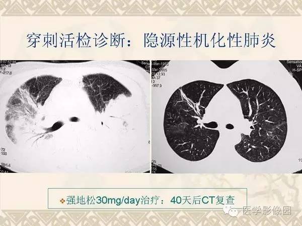 【PPT】隐源性机化性肺炎