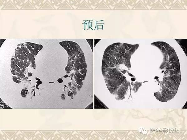 【PPT】隐源性机化性肺炎