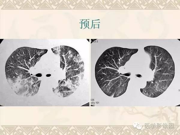 【PPT】隐源性机化性肺炎