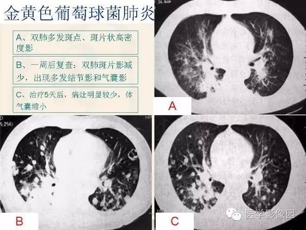 【PPT】隐源性机化性肺炎