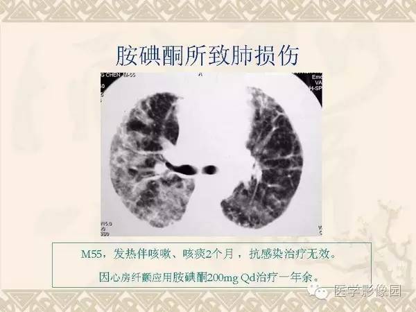 【PPT】隐源性机化性肺炎