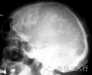 "羊毛颅骨征"，这个征象提示啥？