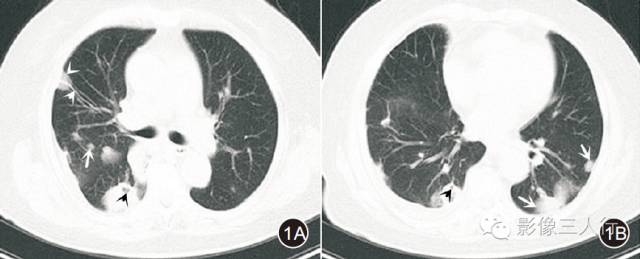 脓毒性肺栓塞的MSCT诊断