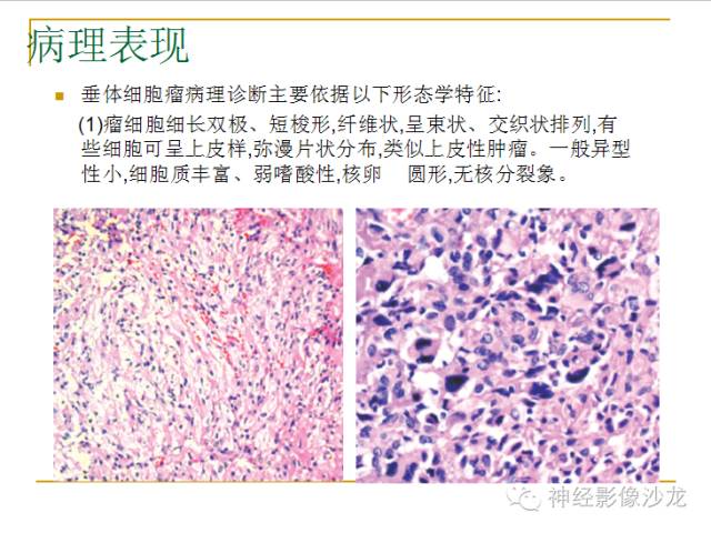 【病例】垂体细胞瘤1例MR影像表现
