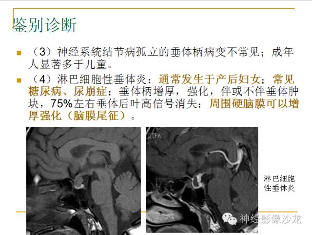 【病例】垂体细胞瘤1例MR影像表现
