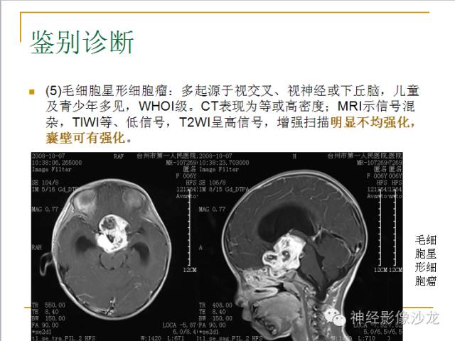 【病例】垂体细胞瘤1例MR影像表现