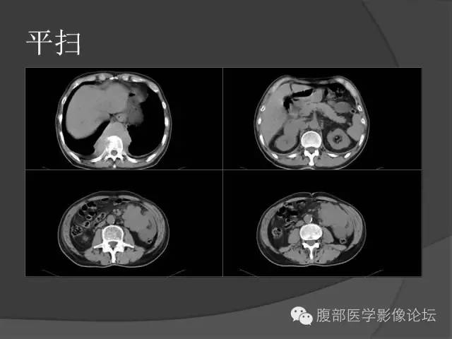 【病例】前列腺非霍奇金淋巴瘤1例