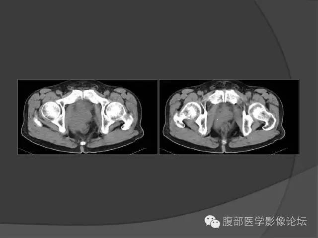 【病例】前列腺非霍奇金淋巴瘤1例 【病例】前列腺非霍奇金淋巴瘤1例