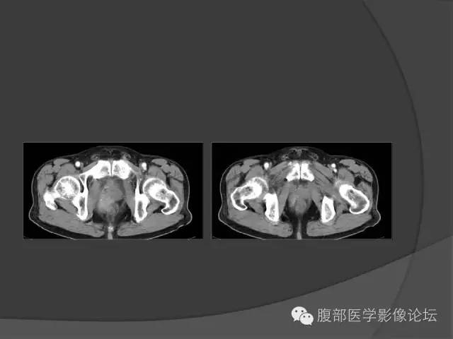 【病例】前列腺非霍奇金淋巴瘤1例 【病例】前列腺非霍奇金淋巴瘤1例