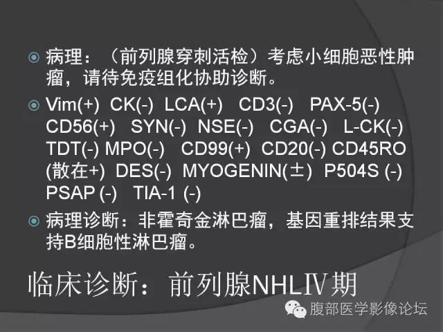 【病例】前列腺非霍奇金淋巴瘤1例 【病例】前列腺非霍奇金淋巴瘤1例