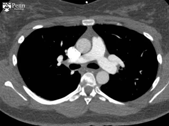 【病例】慢性血栓栓塞性肺动脉高压1例CT 【病例】慢性血栓栓塞性肺动脉高压1例CT