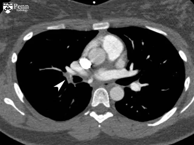 【病例】慢性血栓栓塞性肺动脉高压1例CT
