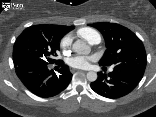 【病例】慢性血栓栓塞性肺动脉高压1例CT 【病例】慢性血栓栓塞性肺动脉高压1例CT