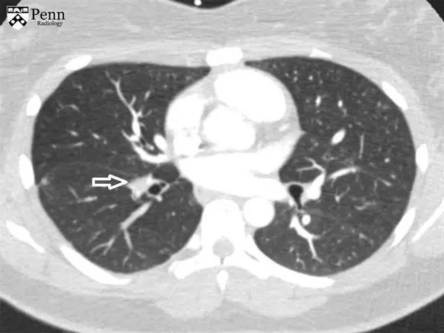 【病例】慢性血栓栓塞性肺动脉高压1例CT 【病例】慢性血栓栓塞性肺动脉高压1例CT