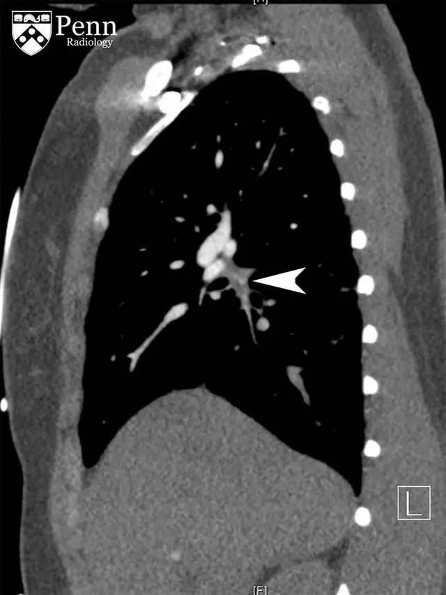 【病例】慢性血栓栓塞性肺动脉高压1例CT 【病例】慢性血栓栓塞性肺动脉高压1例CT