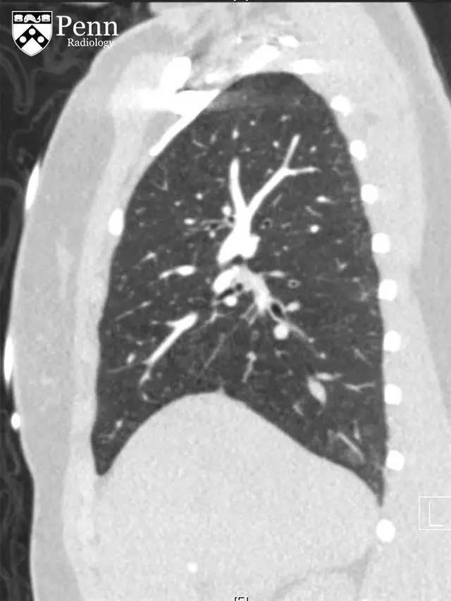 【病例】慢性血栓栓塞性肺动脉高压1例CT 【病例】慢性血栓栓塞性肺动脉高压1例CT