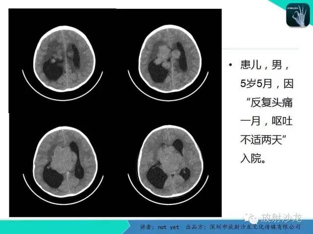【病例】脑室内脑膜瘤1例CT及MR影像表现