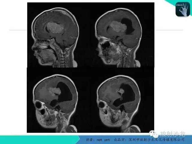 【病例】脑室内脑膜瘤1例CT及MR影像表现