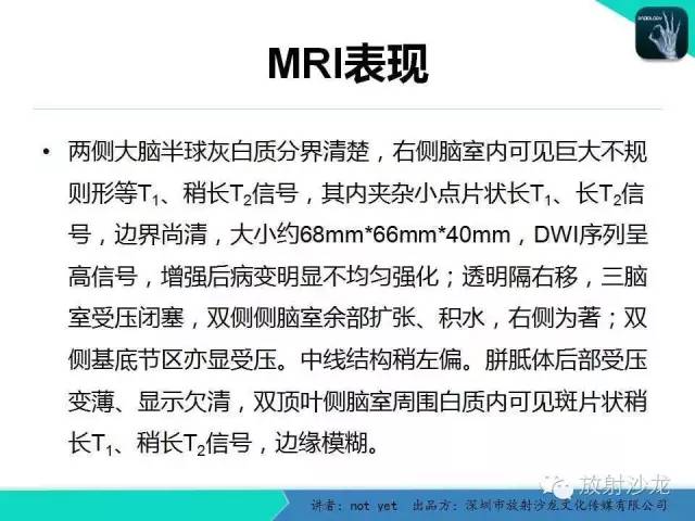 【病例】脑室内脑膜瘤1例CT及MR影像表现