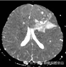 【病例】额叶脑膜瘤1例MR DTI分析