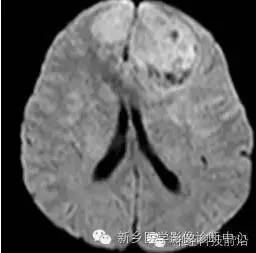 【病例】额叶脑膜瘤1例MR DTI分析