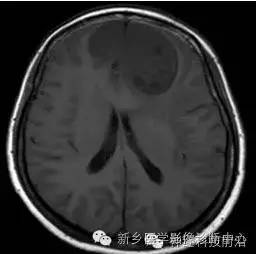 【病例】额叶脑膜瘤1例MR DTI分析