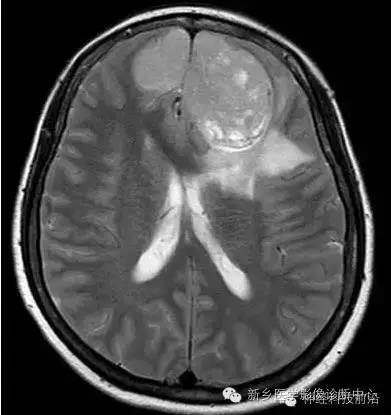 【病例】额叶脑膜瘤1例MR DTI分析