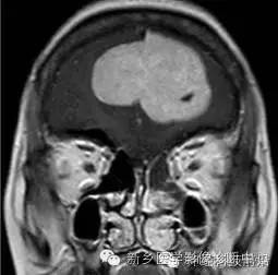 【病例】额叶脑膜瘤1例MR DTI分析