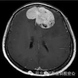 【病例】额叶脑膜瘤1例MR DTI分析
