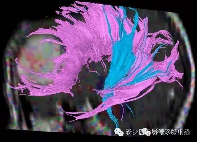 【病例】额叶脑膜瘤1例MR DTI分析