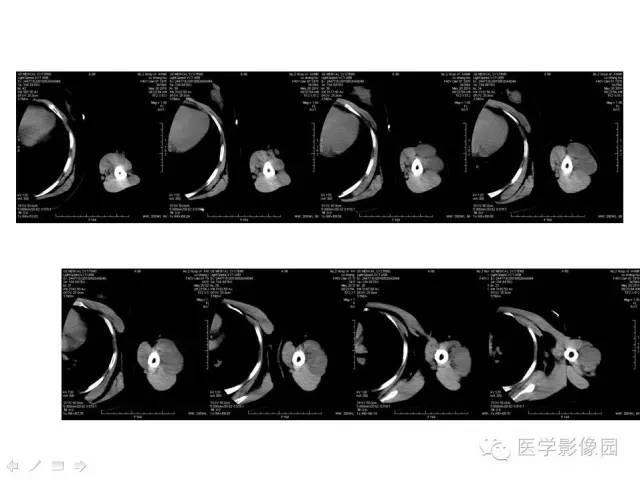 【病例】(左上臂)腹壁外韧带样纤维瘤1例CT及MR 【病例】(左上臂)腹壁外韧带样纤维瘤1例CT及MR