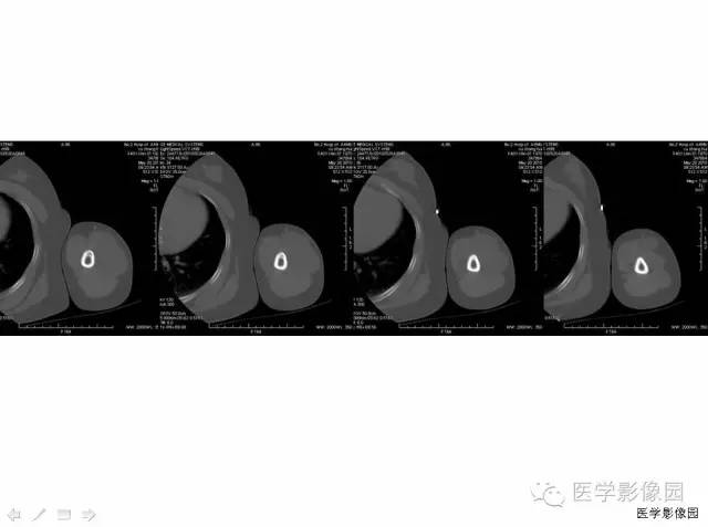 【病例】(左上臂)腹壁外韧带样纤维瘤1例CT及MR 【病例】(左上臂)腹壁外韧带样纤维瘤1例CT及MR