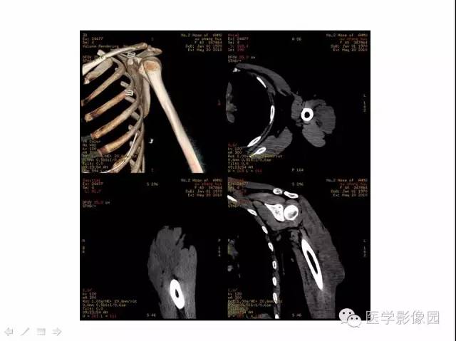 【病例】(左上臂)腹壁外韧带样纤维瘤1例CT及MR 【病例】(左上臂)腹壁外韧带样纤维瘤1例CT及MR
