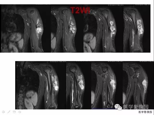 【病例】(左上臂)腹壁外韧带样纤维瘤1例CT及MR 【病例】(左上臂)腹壁外韧带样纤维瘤1例CT及MR