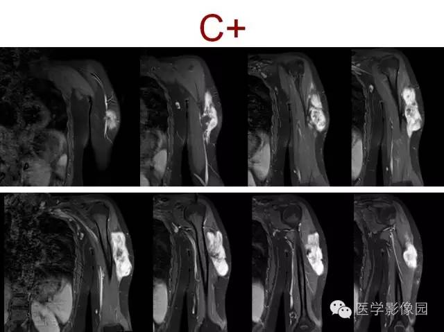 【病例】(左上臂)腹壁外韧带样纤维瘤1例CT及MR 【病例】(左上臂)腹壁外韧带样纤维瘤1例CT及MR