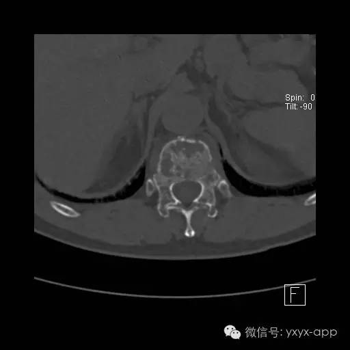 【病例】多发性骨髓瘤1例CT及MR影像表现