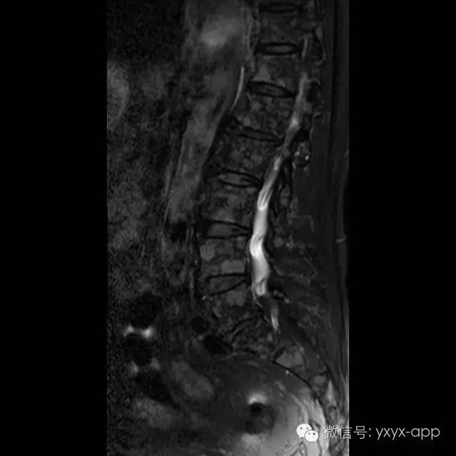 【病例】多发性骨髓瘤1例CT及MR影像表现 【病例】多发性骨髓瘤1例CT及MR影像表现