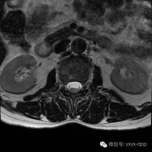 【病例】多发性骨髓瘤1例CT及MR影像表现 【病例】多发性骨髓瘤1例CT及MR影像表现