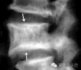 "画框椎"，这个征象提示啥？