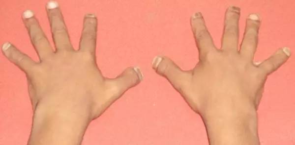 【病例】致密性成骨不全症3例X线CT影像表现