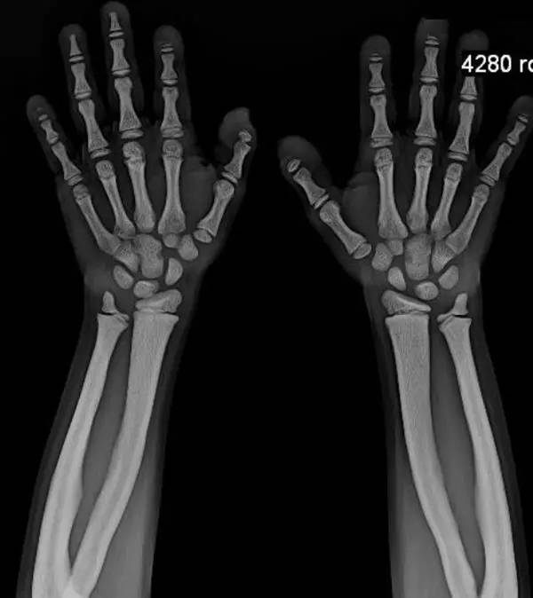 【病例】致密性成骨不全症3例X线CT影像表现