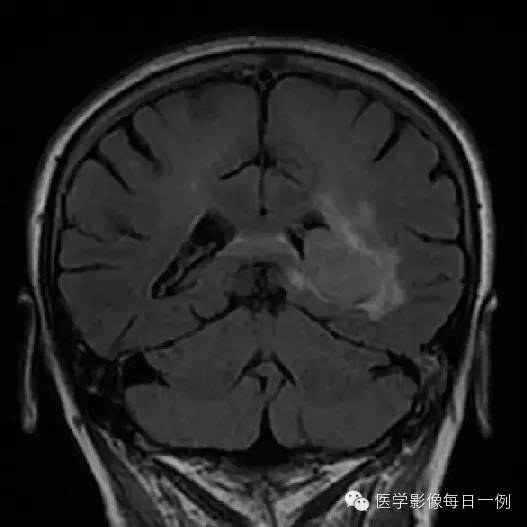 【病例】脑室内脑膜瘤1例CT及MR影像表现