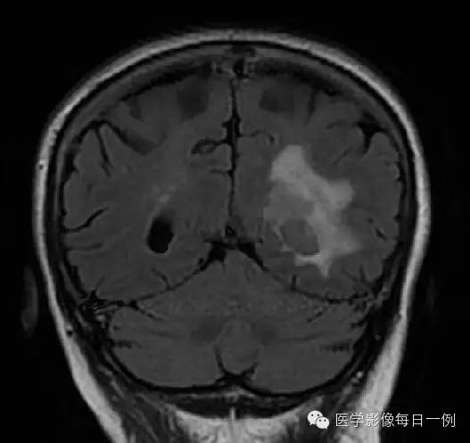 【病例】脑室内脑膜瘤1例CT及MR影像表现