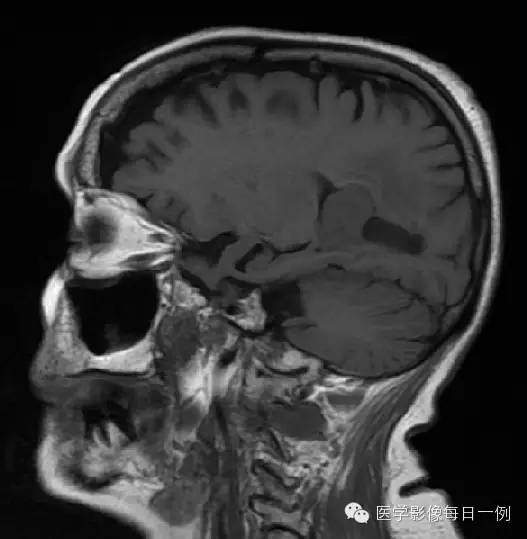 【病例】脑室内脑膜瘤1例CT及MR影像表现