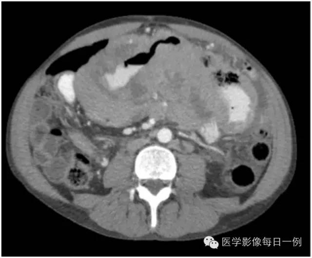 【病例】小肠淋巴瘤1例CT影像表现