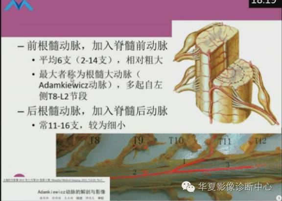 【PPT】脊髓血管畸形：MR诊断