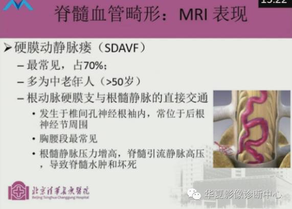 【PPT】脊髓血管畸形：MR诊断