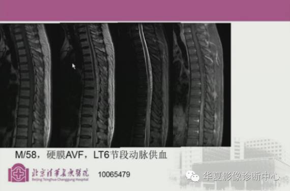 【PPT】脊髓血管畸形：MR诊断